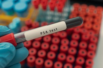 Test PSA – na czym polega to badanie?