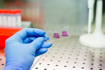 Biopsja gruboigłowa. Jak przebiega i jak się do niej przygotować?