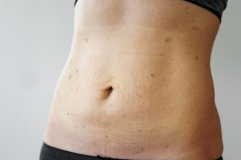 Liszaj płaski – przyczyny, objawy, leczenie