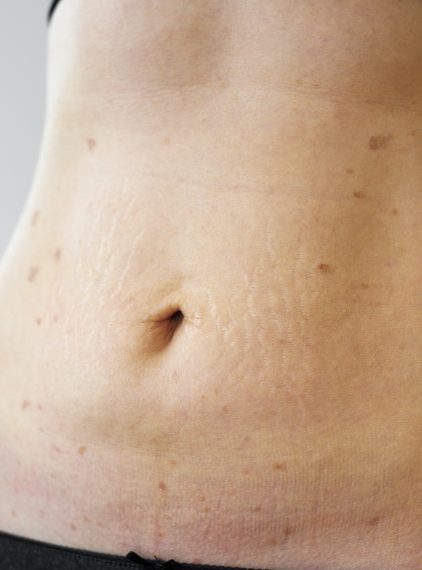 Liszaj płaski – przyczyny, objawy, leczenie