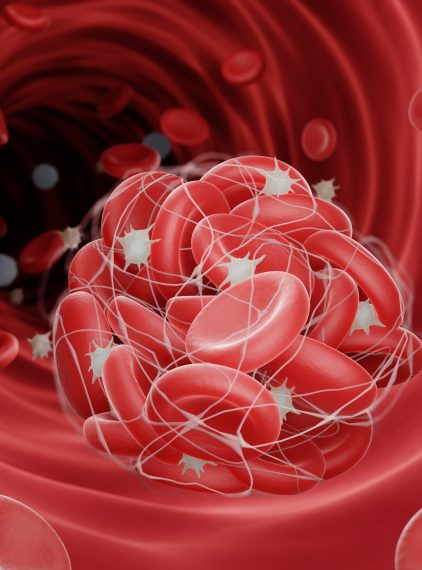 Trombofilia – przyczyny, objawy, leczenie