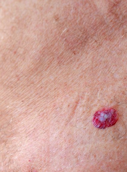 Rak podstawnokomórkowy. Jakie są jego objawy?