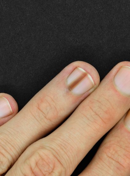 Czerniak paznokcia. Jak go rozpoznać?