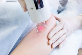 Laseroterapia. Usunie blizny i uśmierzy ból