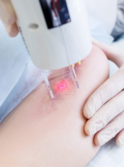Laseroterapia. Usunie blizny i uśmierzy ból