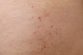 Wybroczyny. Niegroźne zmiany czy objaw choroby?