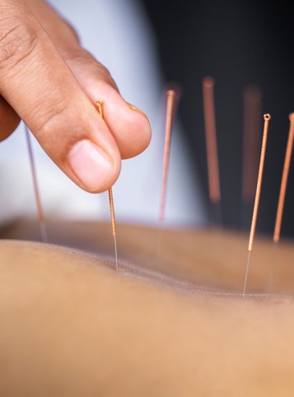 Akupunktura. Czy nakłuwanie igłami działa?