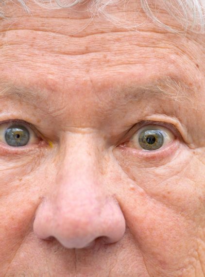 Anizokoria. Czy nierówne źrenice świadczą o chorobie?