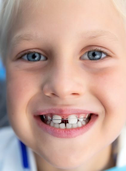 Diastema. Czy wymaga leczenia?