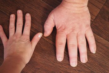 Akromegalia. Co to za choroba?