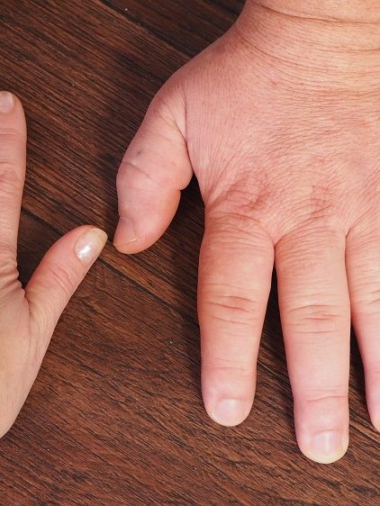 Akromegalia. Co to za choroba?