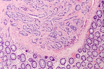 Zespół rakowiaka. Czy jest uleczalny?