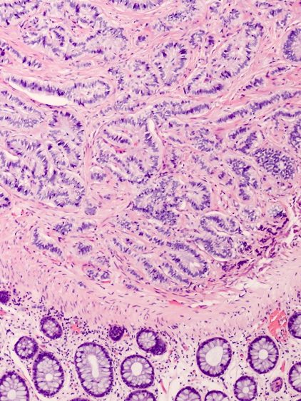 Zespół rakowiaka. Czy jest uleczalny?