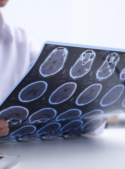 Padaczka lekooporna. Co zamiast leków?