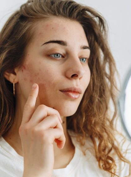 Co na trądzik? Ranking kosmetyków do cery trądzikowej