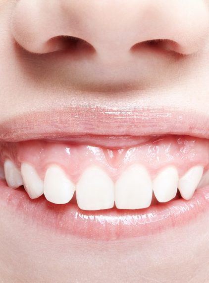 Gummy smile. Czy można zmniejszyć widoczność dziąseł?