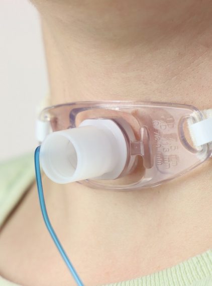 Tracheotomia. Na czym polega?