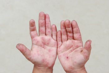 Pęcherzyki na skórze dziecka. O jakich chorobach mogą świadczyć?