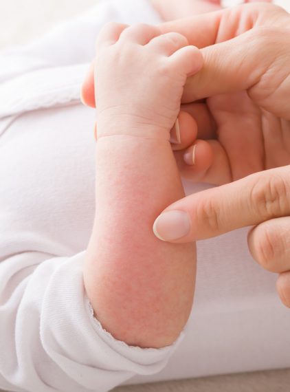 Dysplazja ektodermalna. Czy można ją wyleczyć? 