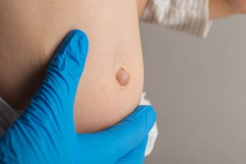 Przepuklina u dziecka. Czy zawsze trzeba ją operować?