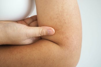 Neurofibromatoza. Jak rozpoznać zmiany skórne?