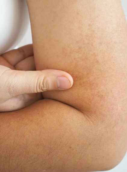 Neurofibromatoza. Jak rozpoznać zmiany skórne?
