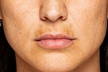 Przebarwienia na twarzy. Skuteczne sposoby