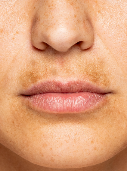 Przebarwienia na twarzy. Skuteczne sposoby