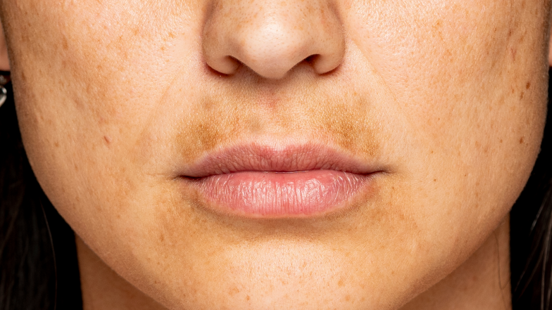 Przebarwienia na twarzy. Skuteczne sposoby