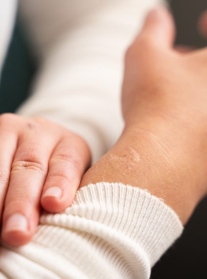 Czy dbanie o bliznę ma znaczenie? Fakty i mity