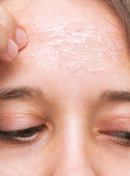 Łuszcząca się skóra twarzy. Jak pokonać ten problem?