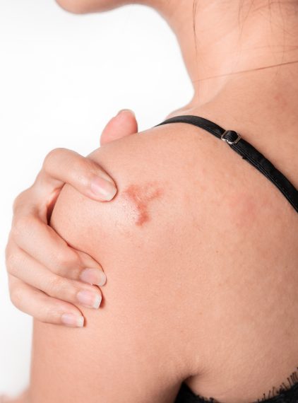 Najlepsze maści, kremy i żele na blizny. Jak wybrać najskuteczniejszy preparat?