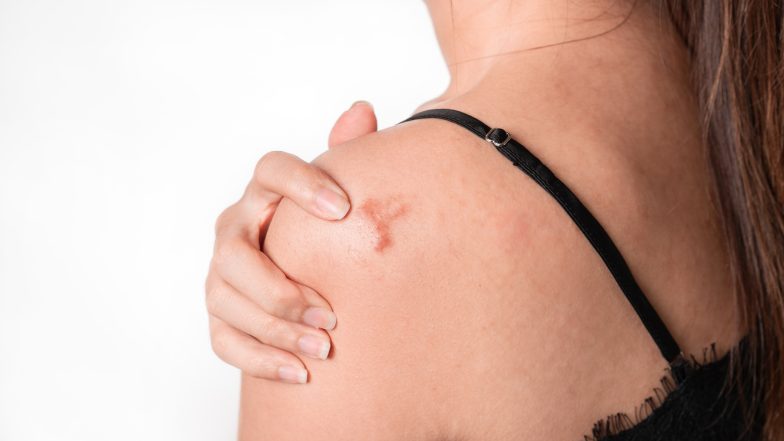 Najlepsze maści, kremy i żele na blizny. Jak wybrać najskuteczniejszy preparat?