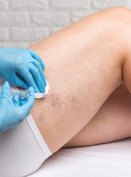 Skleroterapia. Czym jest i na czym polega?