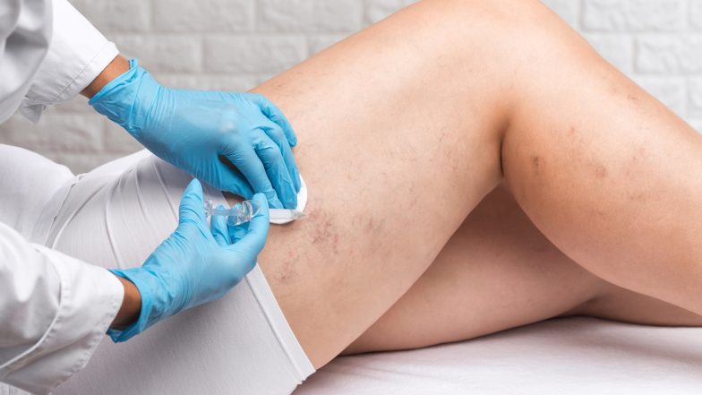 Skleroterapia. Czym jest i na czym polega?