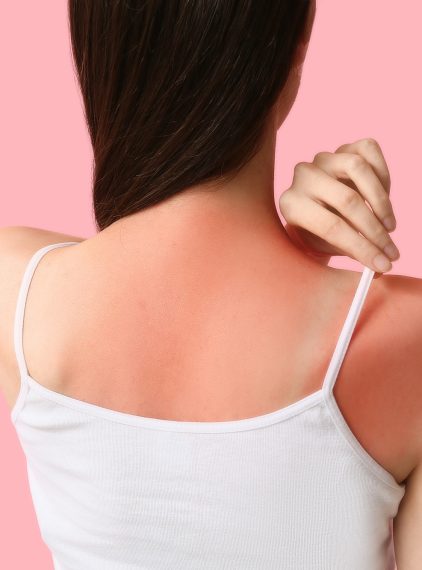 Najlepszy krem na oparzenia słoneczne. Jak pomóc skórze po słońcu?