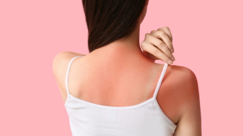 Najlepszy krem na oparzenia słoneczne. Jak pomóc skórze po słońcu?