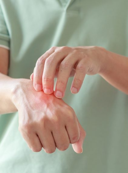 Najlepsza maść na ukąszenia. Przegląd preparatów