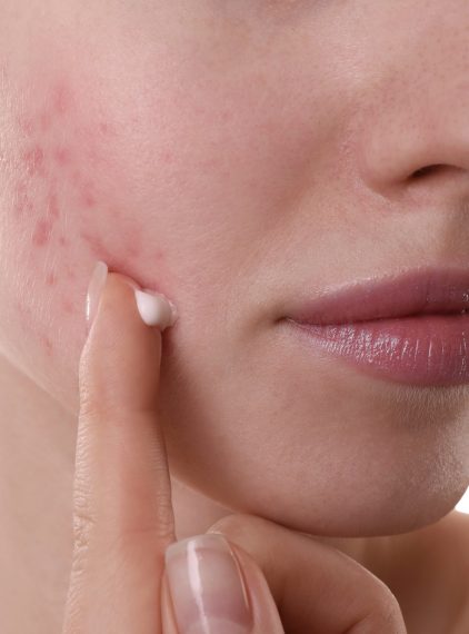 Najlepsze kremy do cery naczynkowej. Jak zadbać o skórę skłonną do zaczerwienień? 