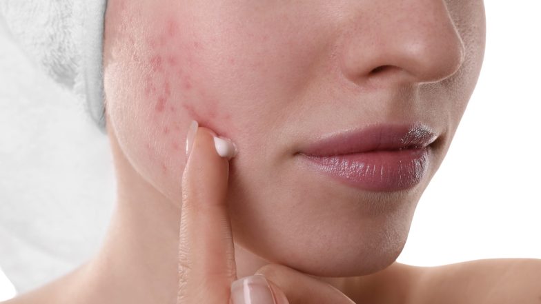 Najlepsze kremy do cery naczynkowej. Jak zadbać o skórę skłonną do zaczerwienień? 