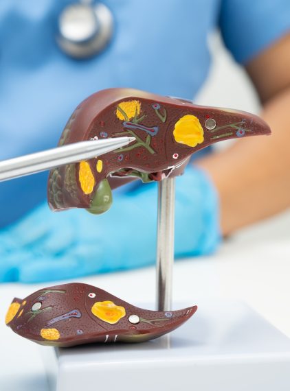 MASLD – co to jest? Objawy, przyczyny i leczenie stłuszczenia wątroby