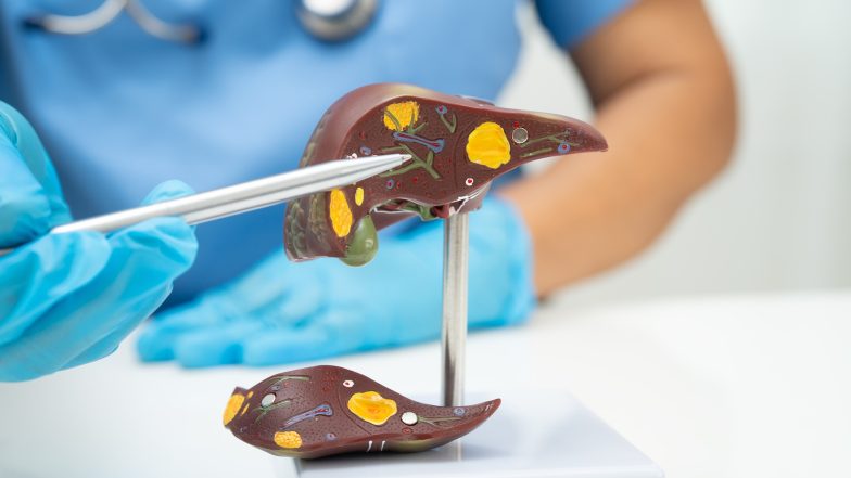 MASLD – co to jest? Objawy, przyczyny i leczenie stłuszczenia wątroby