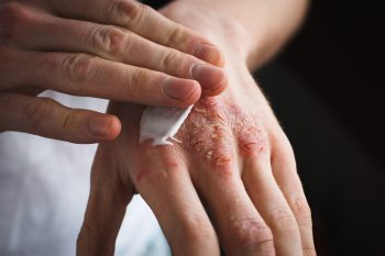 Rybia łuska. Choroba genetyczna skóry