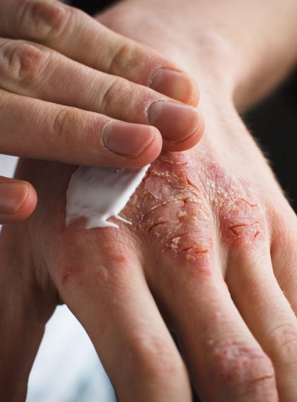 Rybia łuska. Choroba genetyczna skóry