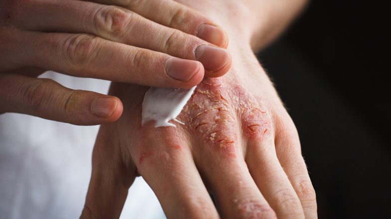 Rybia łuska. Choroba genetyczna skóry