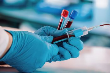 Lipoproteina (a). Normy, badanie i przyczyny podwyższonego wyniku