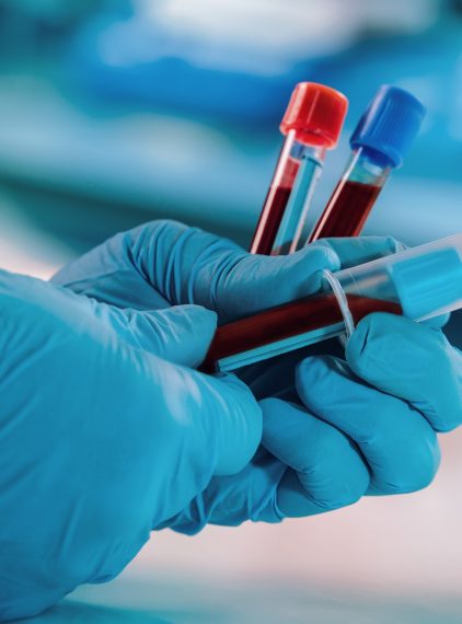 Lipoproteina (a) – normy, badanie i przyczyny podwyższonego wyniku