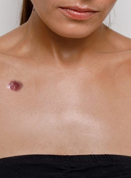 Melanotan, czyli „Barbie drug”, pod lupą naukowców. Nowe przypadki budzą niepokój