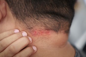 Łojotokowe zapalenie skóry – jaka maść i jaki szampon? Przegląd preparatów