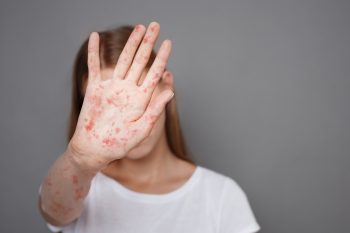 Największa epidemia odry na świecie. Ponad 167 tys. podejrzanych przypadków i ponad 1000 zgonów